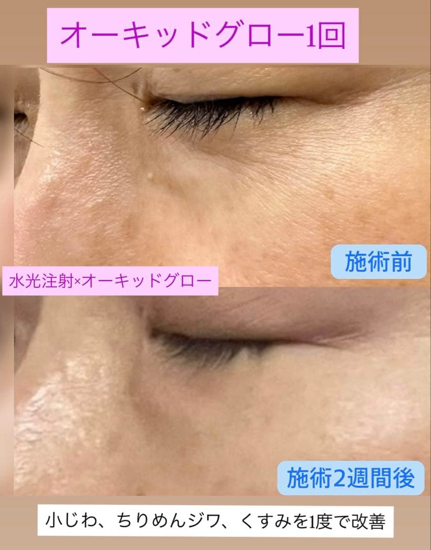 美容オタクのハナネェ　オーキッドグロー、高純度リジュラン